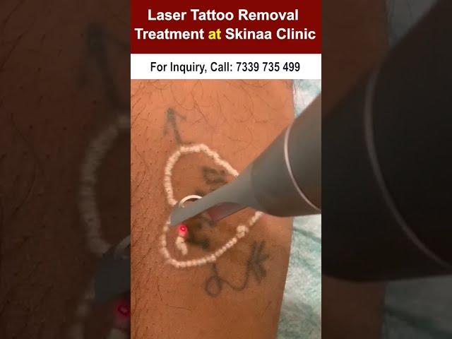 Laser Tattoo Removal at Skinaa Clinic #viralshorts  #lasertattooremoval #skinaaclinic #shorts