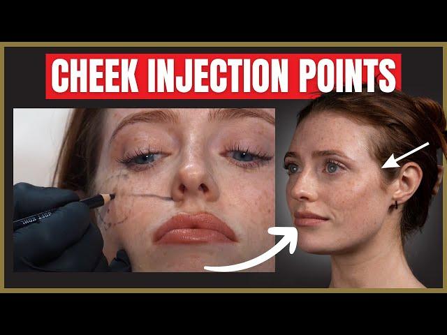 The Best Cheek Filler Injection Points | Where to inject the cheek for beautiful results.