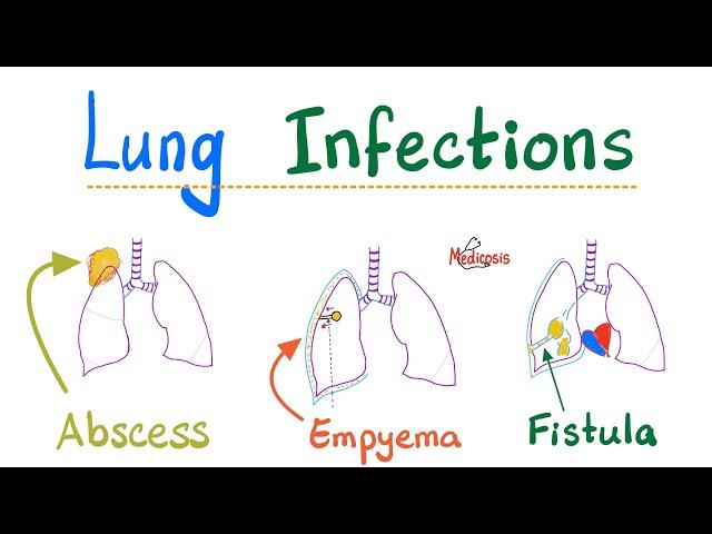 Lung Infections - Lung Abscess, Empyema, Fistula, Aspiration Syndromes, Systemic fungi - Pathology