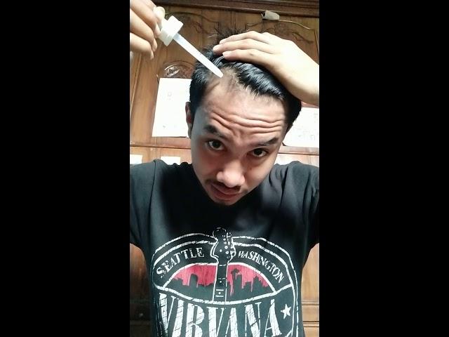 Nyesel Pake Minoxidil 4 bulan!