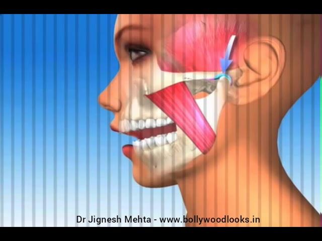 Migraine / Headache. Understand Balanced Occlusion