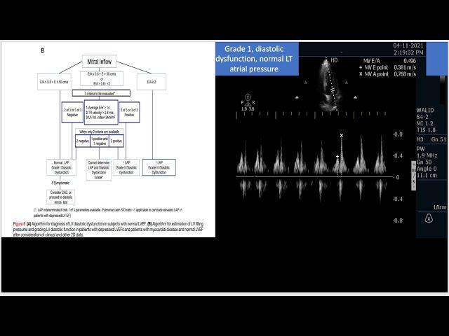 An evidenced based step by step approach to manage a mixed shock  by critical care Echocardiography