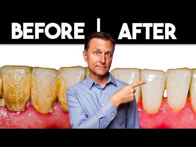 Preventing Dental Plaque Formation Forever: Simple Solution