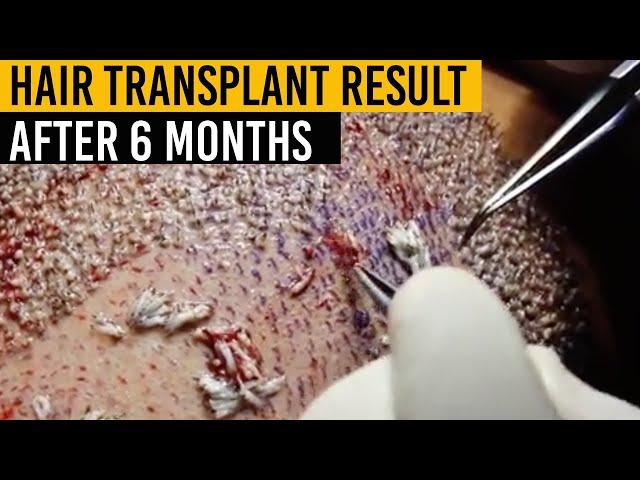 Je Amöur || Hair Transplant || Result || With Dr.Swati Garg After 6-Months ||