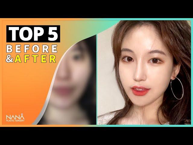 [SUB] TOP 5 Facial Plastic Surgery Before and After | NANA Plastic Surgery Hospital in Korea