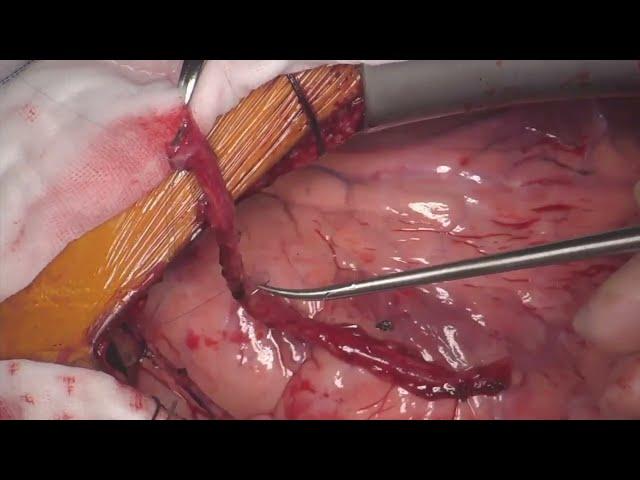 Off-Pump Coronary Artery Bypass Grafting: RA to LIMA 'T' Graft