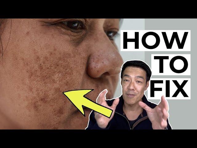 How do Dermatologists FIX Pigmentation? (PIH)