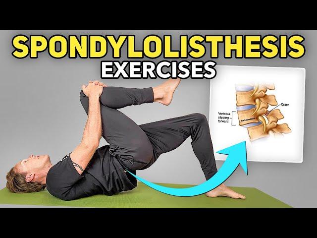 5 Exercises for Lumbar Spondylolisthesis