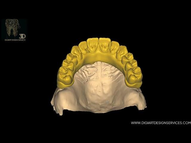 Implant Bridge using Exocad Software at Digiart Design Services