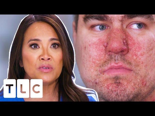 Dr Lee Treats Autistic Man For Skin Condition Common In People With Special Needs | Dr Pimple Popper
