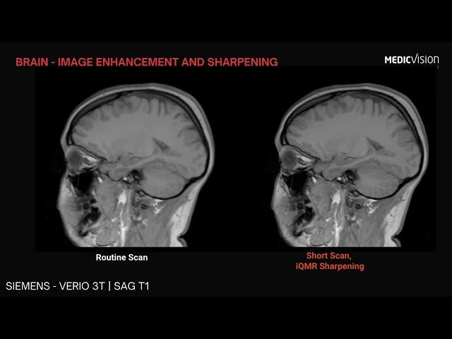 iQMR MRI Image enhancement: Brain scan, Siemens SAG T1 POST