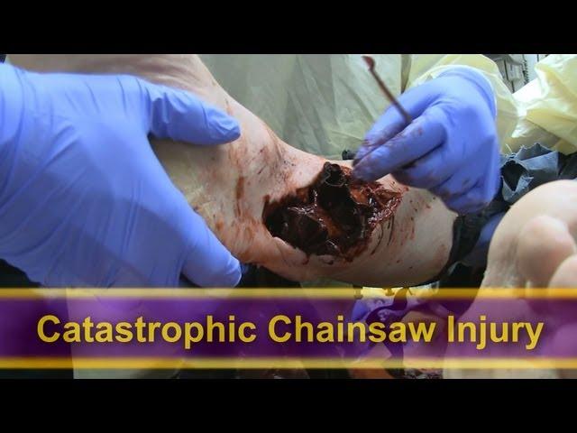 Catastrophic Chainsaw Accident (Viewer Discretion Advised)