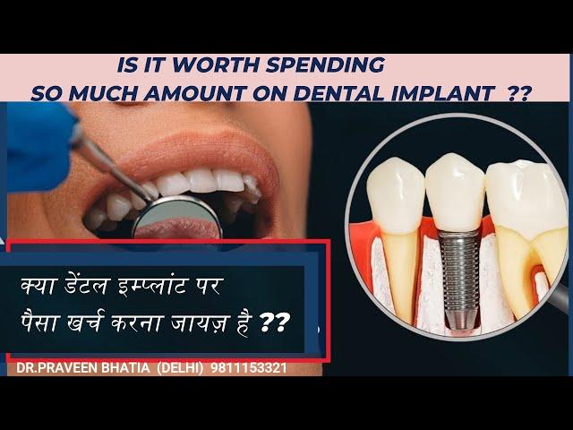 क्या डेंटल इम्प्लांट पर पैसा खर्च करना जायज़ है ??Is It Worth Spending So Much on Dental Implants?