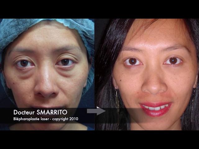 Laser Blepharoplasty Dr SMARRITO - Chirurgie des paupières au laser.