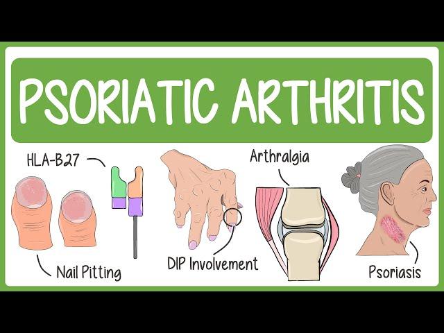 Psoriatic Arthritis with Mnemonics