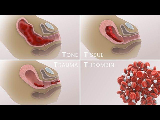 Management of Postpartum Hemorrhage (PPH) | Etiologies, prevention, treatment | TVASurg