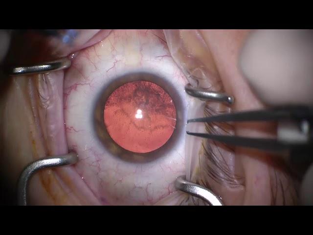 My Cataract Surgery