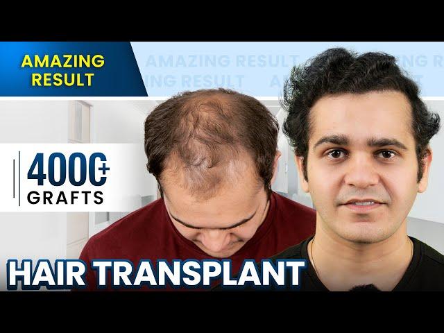 Grade 5 Hair Transplant in Surat | Stunning Hair Transplant Results and Cost #hairtransplant