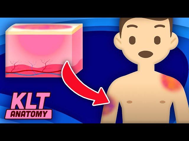 Why Do You Get Bruises?! | KLT Anatomy