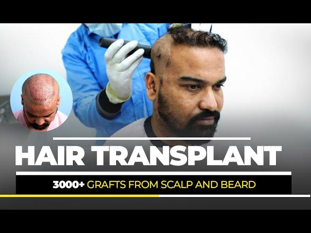 3000+ GRAFTS FROM SCALP AND BEARD !! | BEST HAIR TRANSPLANT CLINIC | DMC TRICHOLOGY