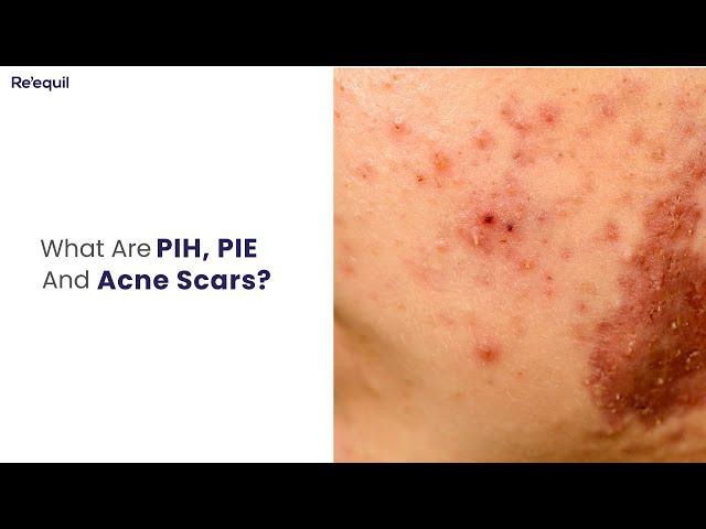 What Are PIH, PIE And Acne Scars?