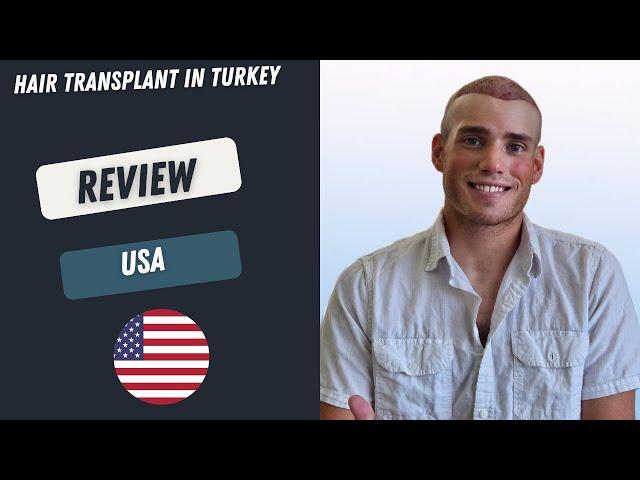 Hair Transplant in Turkey Review l Worbimed Clinic