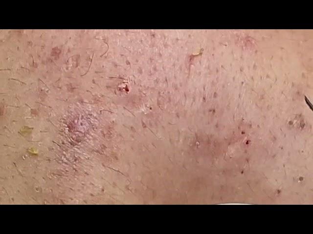 Acne treatment for Spa Linh Mun 2024 #135