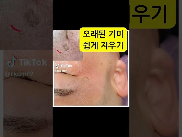오래된 기미 쉽게 지우자#기미#기미제거#기미커버#기미타투#흉터#흉터제거#흉터커버#흉터타투#다크서클타투#다크서클제거#튼살제거#튼살타투#두피관리#탈모관리#헤어라인타투#두피문신#대구타투