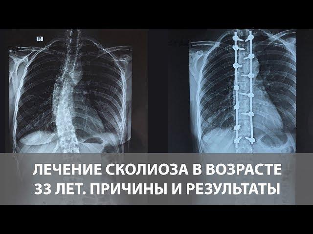 Сколиоз грудного отдела позвоночника - операция в 33 года | Диагностика и лечение сколиоза | Отзыв