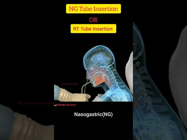 NG ( Nasogastric ) Tube Insertion Techniquen In Hindi  ll RT Tube Insertion Procedure ll SG Pharma