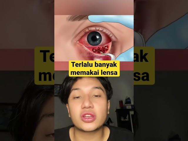 TERLALU BANYAK MEMAKAI LENSA #viral