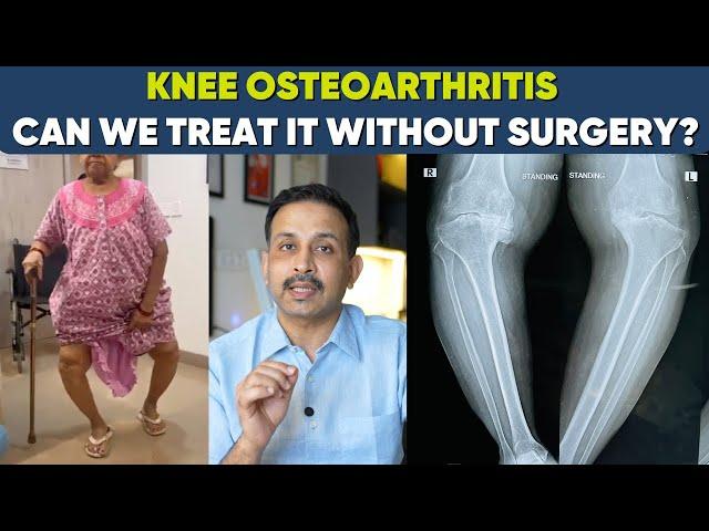 Knee arthritis-Is Surgery the Only Option?