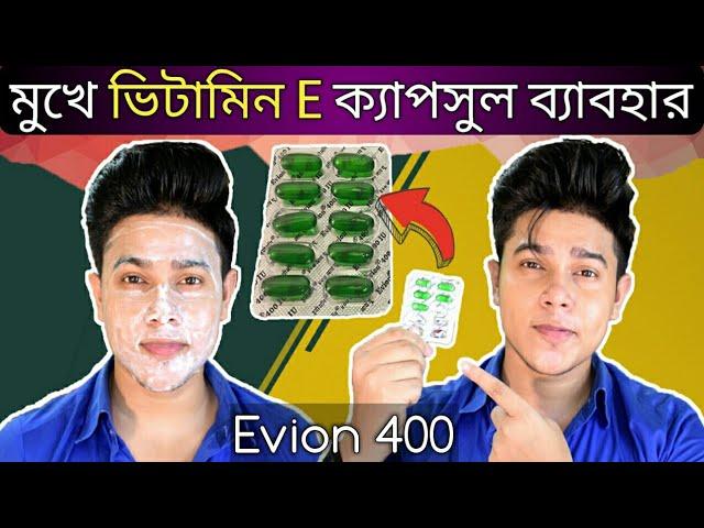 Evion 400 এর সাহায্যে মুখ ফর্সা এবং ব্রণ কমানোর 100 % কার্যকরী সহজ উপায় | ভিটামিন ই ক্যাপসুল