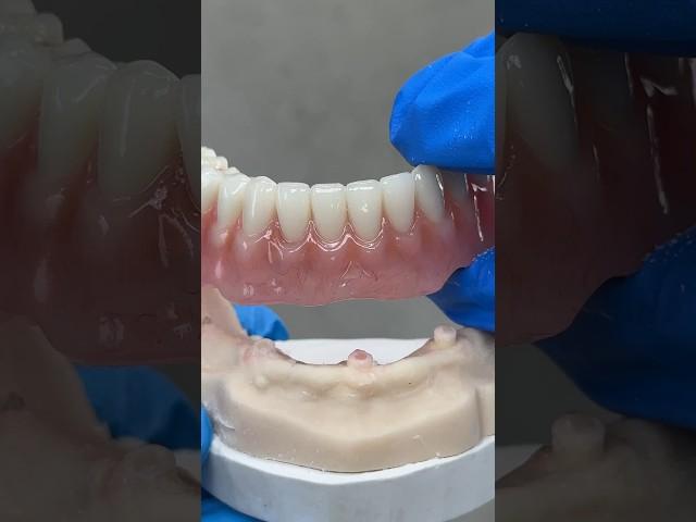 3-Locator Hybrid Denture @EnvisiontecMain #envisiontec #lsk121shorts #teeth #dental