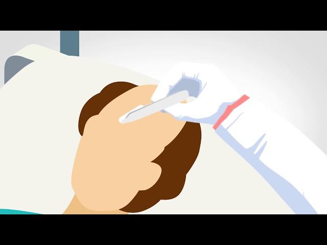 How Does Hair Implantation Works? | Modified Hair Implant | MHI | Vplant Advannced Hair Clinic