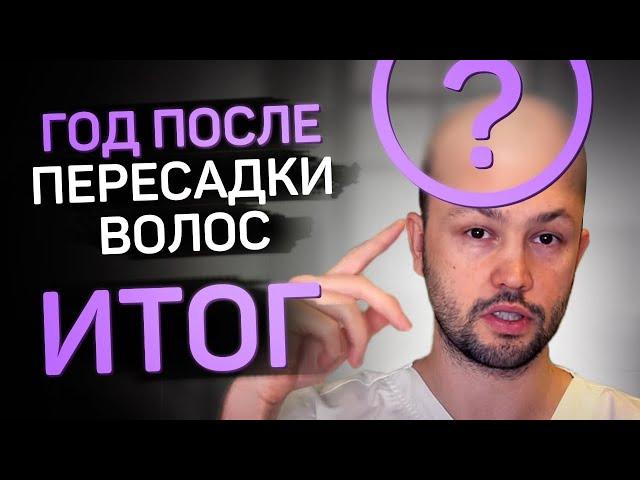 Пересадка волос. Год спустя. Полный итоговый отчет.