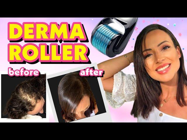 DIY TREATMENT DERMA ROLLER FOR HAIR LOSS + MIRACLE SECRET CURE!