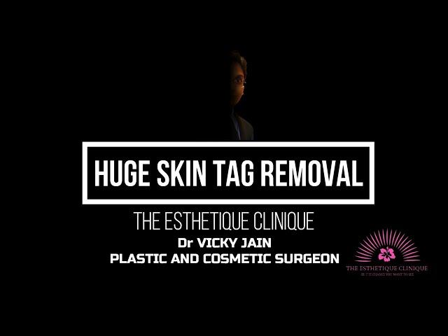 PEDUNCULATED FIBROLIPOMA |BIG SKIN TAG REMOVAL |DR VICKY JAIN |PLASTIC AND COSMETIC SURGEON | LIPOMA