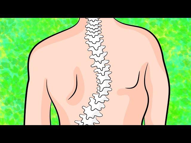 How to get rid of upper back scoliosis in 4 minutes a day