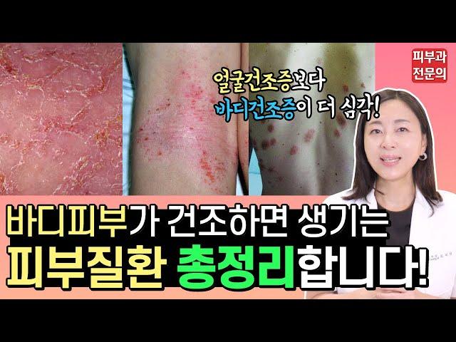 환절기특집) 얼굴피부 건조증보다 바디피부 건조증이 더 위험합니다!!! 바디가 건조하면 생기는 피부질환 총정리! 바디건조증 잡는법 공개