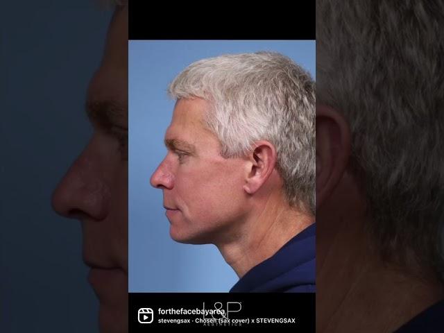 Male Deep Plane Facelift | L&P Aesthetics, the Bay Area's Top Facial Plastic Surgeons