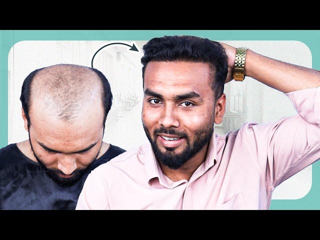 Watch This Amazing 7 Month Hair Transformation  | Hair Transplant in Bangladesh | New Roots