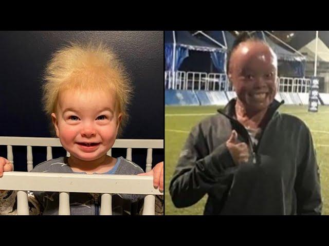 Uncombable Hair Syndrome and Other Rare Genetic Conditions