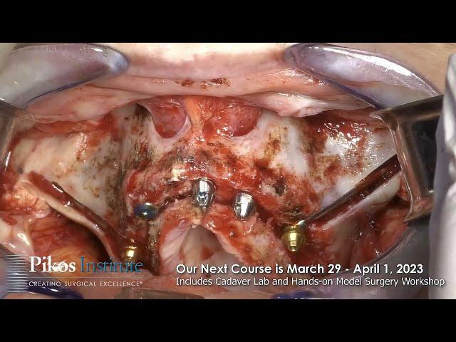 Hybrid Zygomatic Implant Case Pikos Institute Zygomatic and Pterygoid Implant Course