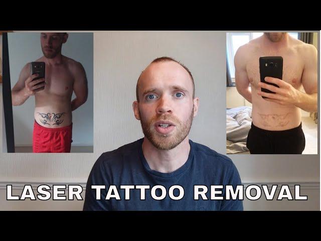 Laser Tattoo Removal  - Sessions 10-12 Update