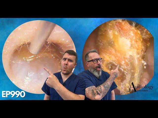 HUGE POLYPS, PEELS & MASSIVE EAR WAX PLUGS - EP990