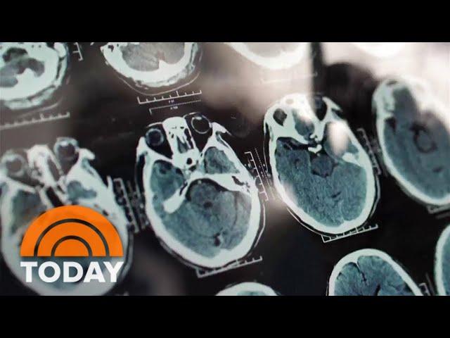 How AI can help detect early warning signs of Alzheimer’s disease