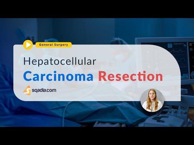 Hepatocellular Carcinoma Resection | Pathology and Cancer Staging Systems | TRAILER