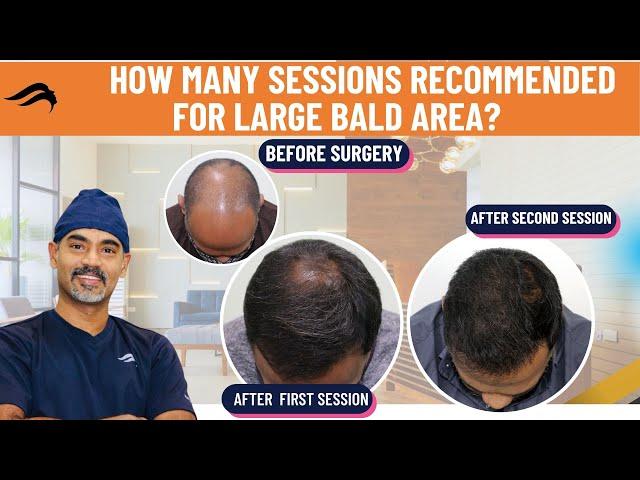 Hair Transplant In Chennai | Best Clinic Surgeon Results & Cost Of Hair Transplant Of Chennai