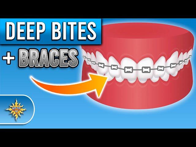 How Do Braces Fix Deep Bites? | Premier Orthodontics